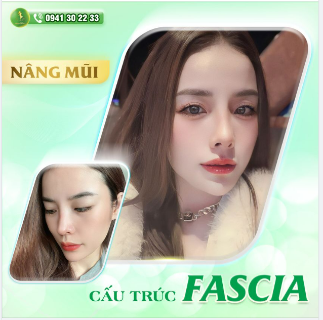 THU TRANG TRẢI NGHIỆM CÔNG NGHỆ NÂNG MŨI CẤU TRÚC FASCIA