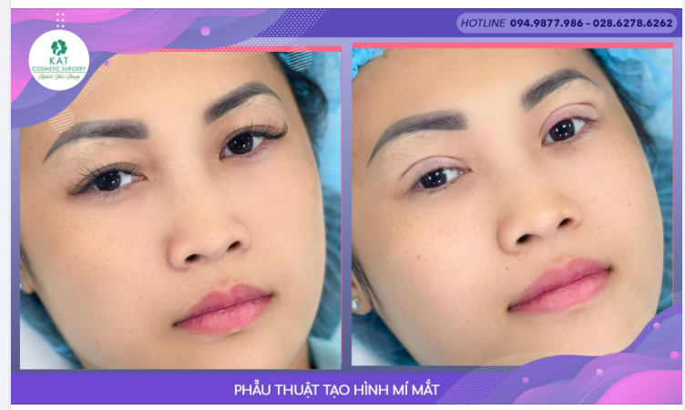 Một sự thay đổi kỳ diệu chỉ với 15phút . Bạn có tin đây là cùng một đôi mắt