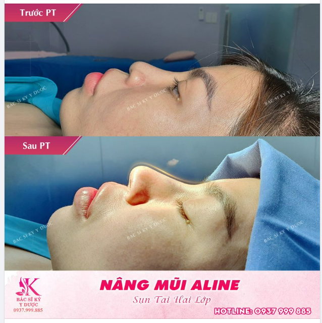 DÁNG MŨI ALINE CÂN MỌI GÓC MẶT