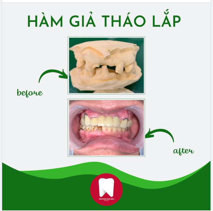 HÀM THÁO LẮP - GIẢI PHÁP TỐI ƯU TIẾT KIỆM CHI PHÍ