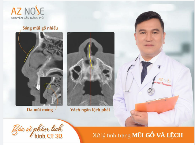 Khắc phục g.ồ - l.ệ.ch bẩm sinh cho khách hàng 2K2