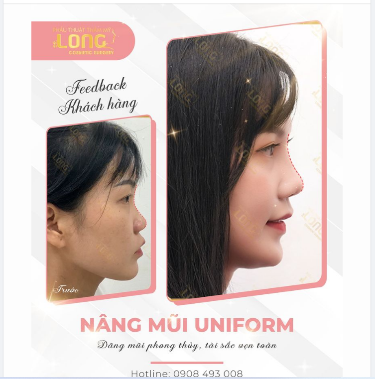BẠN ĐANG LO LẮNG VỀ CHI PHÍ NÂNG MŨI