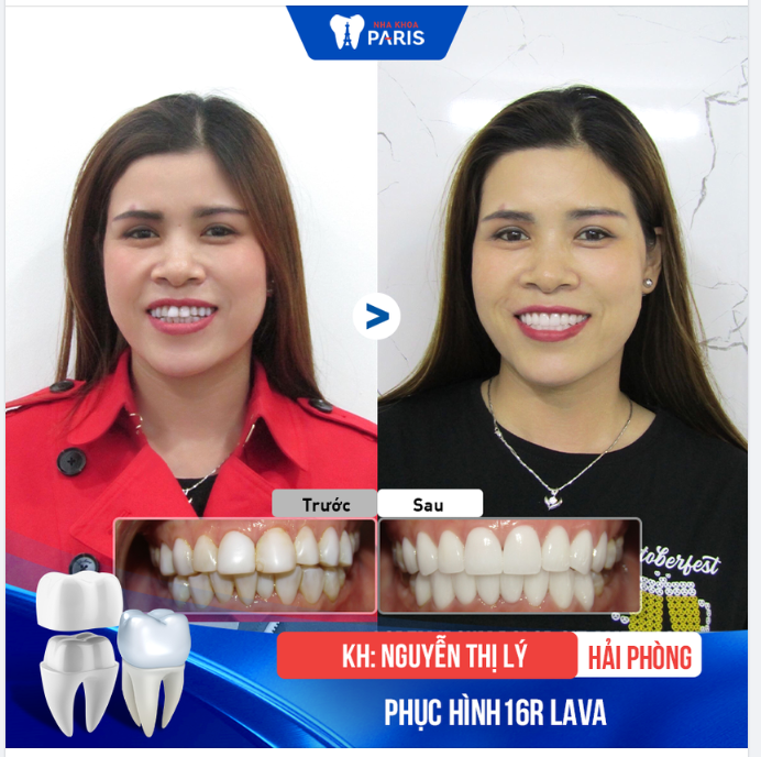 KHẮC PHỤC HÀM RĂNG BỊ VIÊM NƯỚU RĂNG DO PHỦ TRẮNG NANO