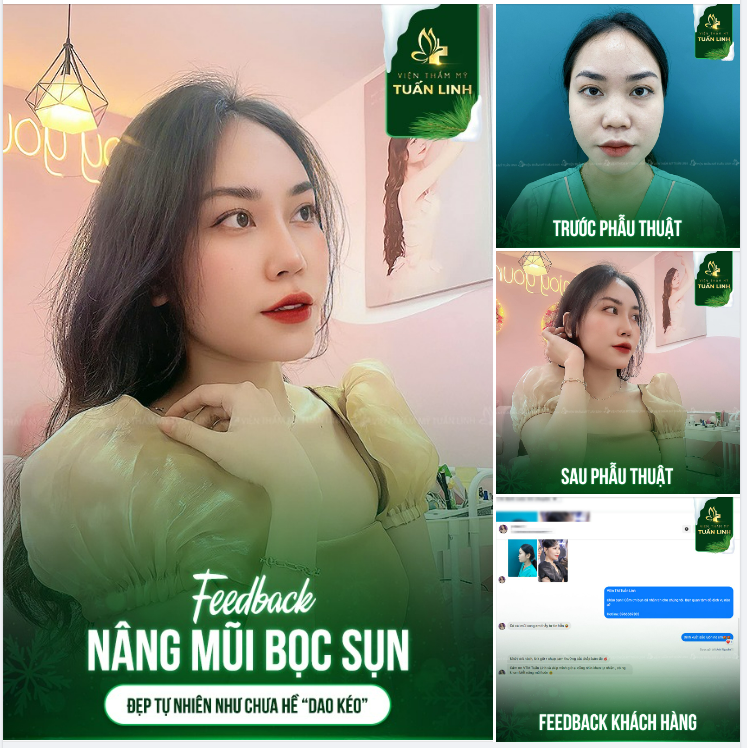 Mũi không có quá nhiều khuyết điểm và muốn lên dáng mũi mới đẹp tự nhiên chọn ngay nâng mũi bọc sụn 