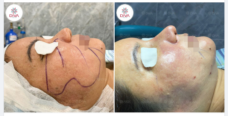 MẶT DÀY MỠ, CÁNH MŨI BÈ - LÀM SAO CẢI THIỆN?