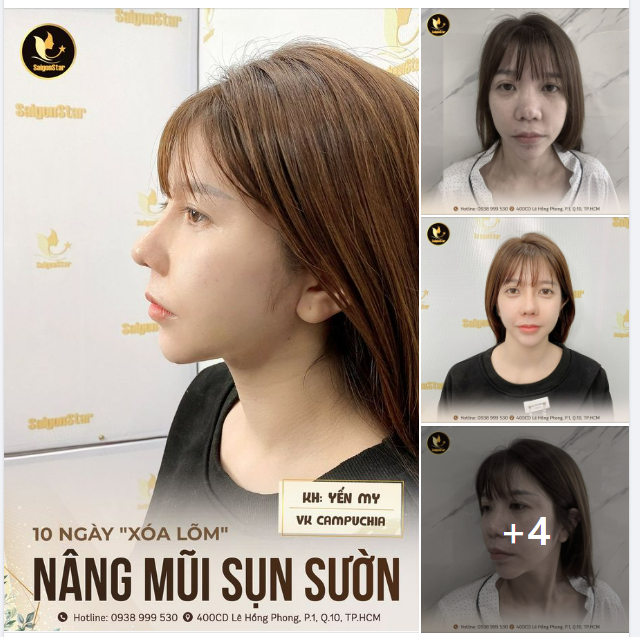 10 NGÀY “XÓA LÕM” NÂNG MŨI SỤN SƯỜN