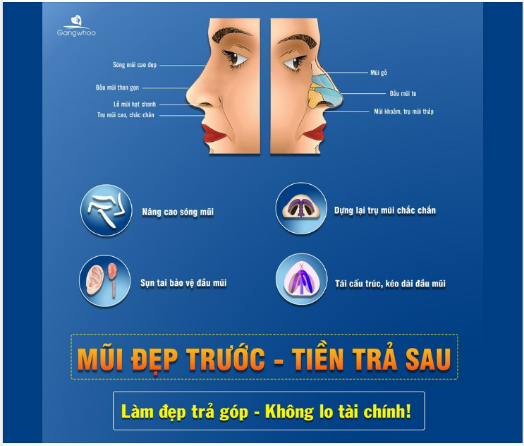 NÂNG MŨI TRẢ GÓP - CHI PHÍ LÀ CHUYỆN NHỎ