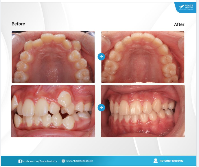 RĂNG CHEN CHÚC KHẤP KHỂNH LỰU CHỌN HIỆU QUẢ NHẤT VẪN LÀ  NIỀNG RĂNG