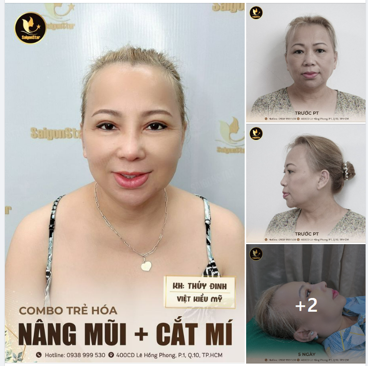 CÔNG THỨC TRẺ HÓA TOÀN DIỆN = ĐẾN SAIGON STAR + NÂNG MŨI + CẮT MÍ