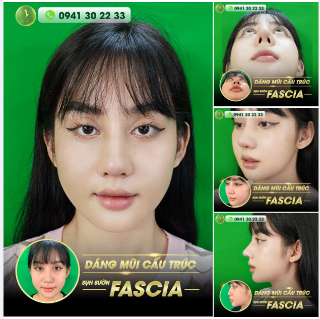 MŨI ĐẸP BỀN VỮNG VỚI GIẢI PHÁP SỤN SƯỜN FASCIA