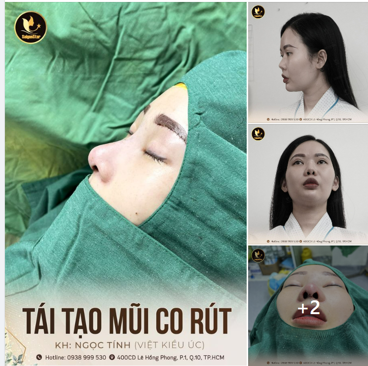 DR. HOẠT – TÁI TẠO MŨI CO RÚT