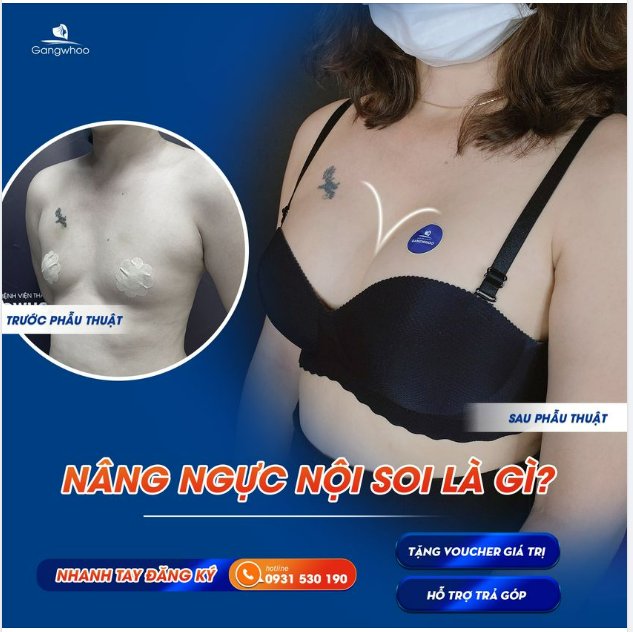 NÂNG NGỰC NỘI SOI LÀ GÌ?