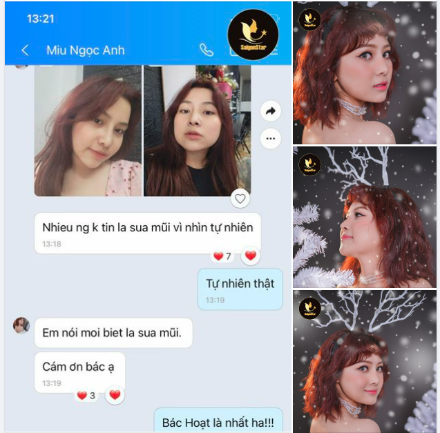 FEEDBACK CỦA NGỌC ANH SAU 1 NĂM NÂNG MŨI