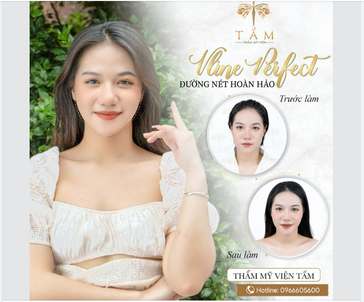 Đẹp hoàn hảo không góc chết với Vline Perfect tại Thẩm mỹ viện Tấm