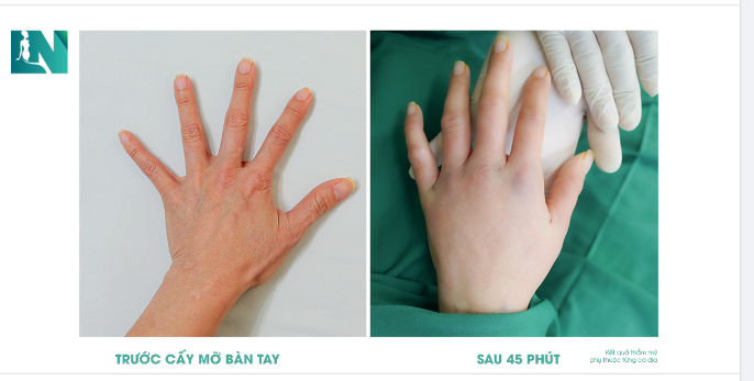 45 PHÚT  CẤY MỠ TRẺ HOÁ BÀN TAY – BÍ QUYẾT ĐÔI BÀN TAY ĐẸP