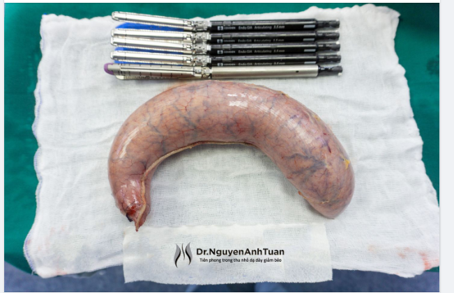 Các bạn có thể quan sát thiết bị cũng như phần dạ dày được cắt bỏ sau khi lấy ra khỏi ổ bụng trong hình phía dưới đây.