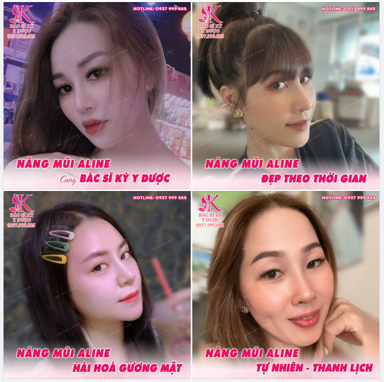 Chỉ với 12 Triệu mà đẹp quá bác sĩ ơi! Nâng mũi ALINE - Độc quyền Bác sĩ Kỳ Y Dược
