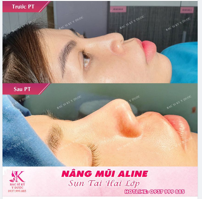 Mũi sửa lại ALINE thần thánh 