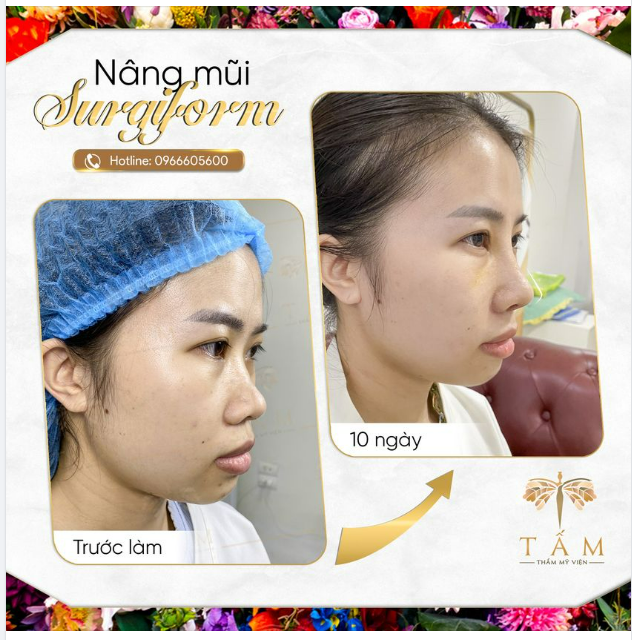 Nâng mũi Surgiform sau 10 ngày với 1 góc nghiêng thay đổi 180 độ