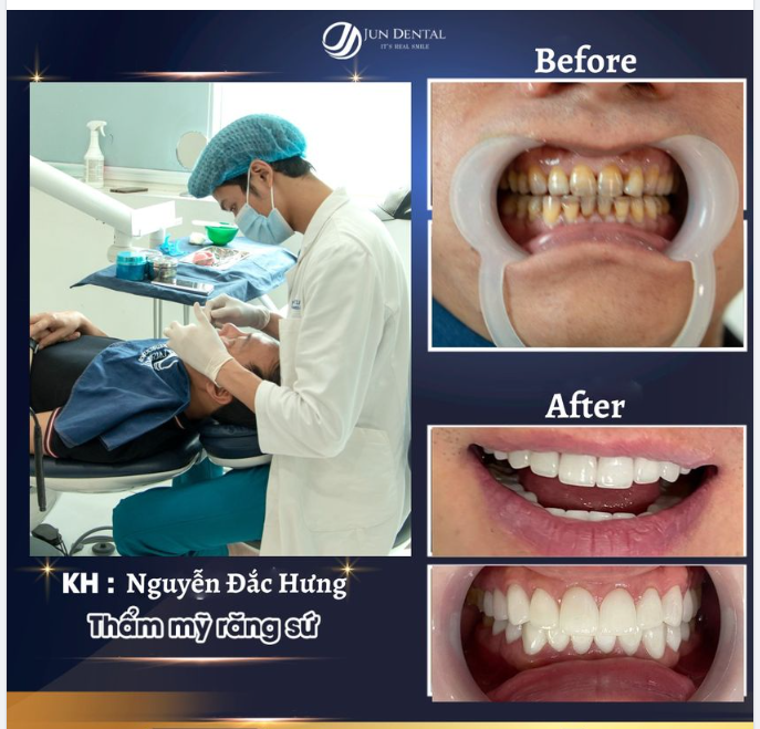 HOÀN HẢO TỪNG MILLIMET LÀ TIÊU CHÍ HÀNG ĐẦU CỦA THẨM MỸ RĂNG SỨ TẠI JUN DENTAL