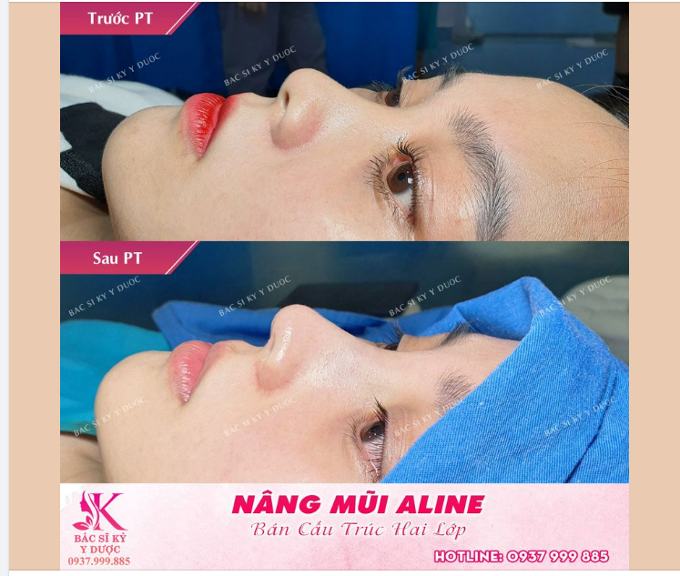 Nâng mũi ALINE bán cấu trúc hai lớp