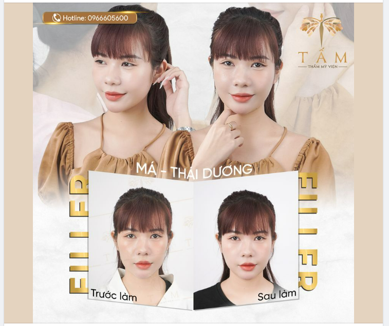 Mặt xinh đón giáng sinh cùng Combo Filler