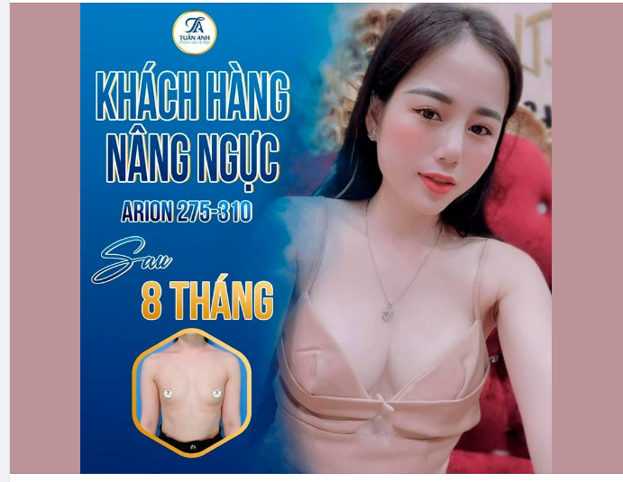 Mắt, Mũi, Ngực của chị đều "madeby" Bác sĩ Tuấn Anh, đẹp và ưng lắm, ai cũng khen xong hỏi làm ở đâu !