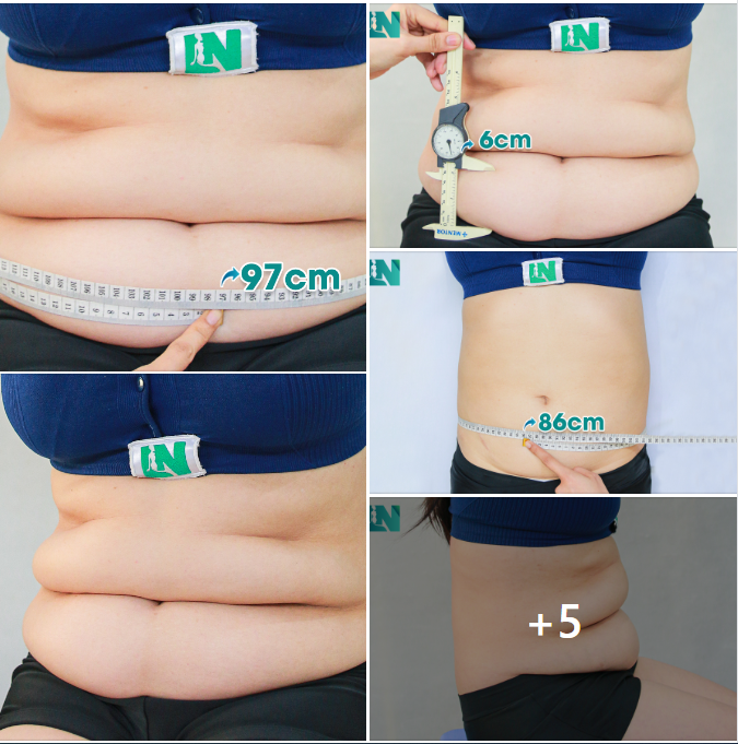 CHỊ KH 42 TUỔI, VÒNG BỤNG CHẢY XỆ NẶNG – LỰA CHỌN GIẢM MỠ AN TOÀN.