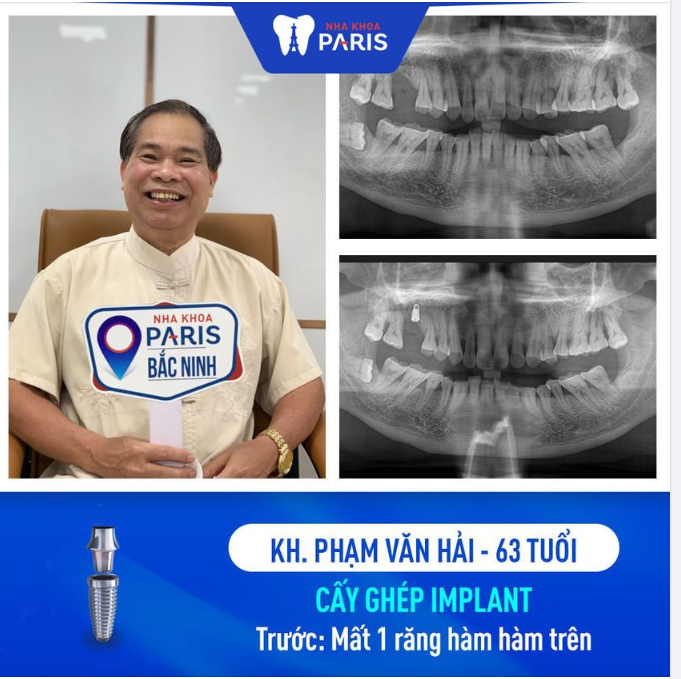 KẾT QUẢ TRỒNG RĂNG HÀM TRÊN CỦA CHÚ HẢI
