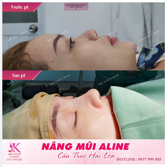 Nâng mũi ALINE độc quyền tại Bác sĩ Kỳ Y Dược