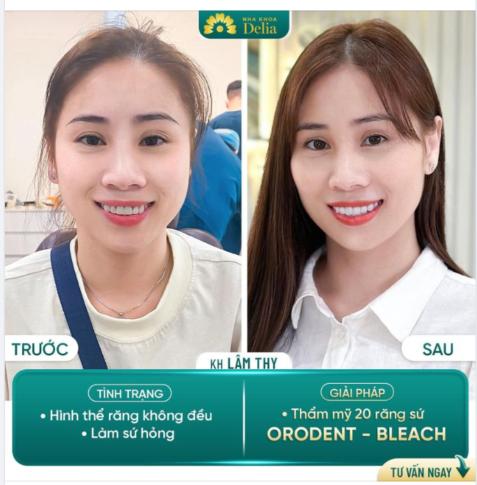 Thẩm mỹ 20 răng sứ Orodent Bleach - Điểm tựa giúp ca sĩ hải ngoại Lâm Thy tự tin cười tươi mỗi ngày
