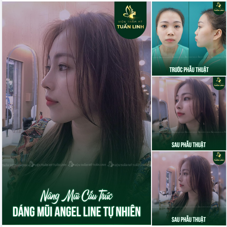 Chiếc mũi thấp tẹt, đầu mũi ngắn hếch làm cho khuôn mặt của cô ấy nhạt nhòa, không cân đối.