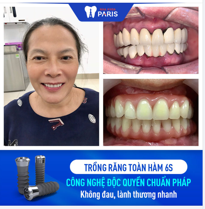 CÔ DUNG TRỒNG RĂNG IMPLANT TOÀN HÀM