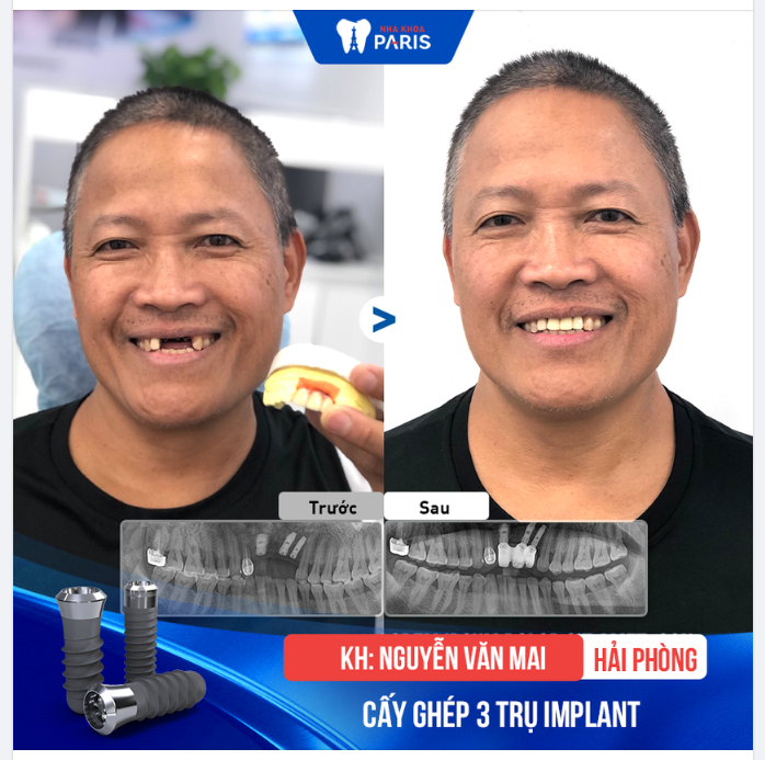 KẾT QUẢ CẤY GHÉP IMPLANT CỦA CHÚ MAI - 60 TUỔI