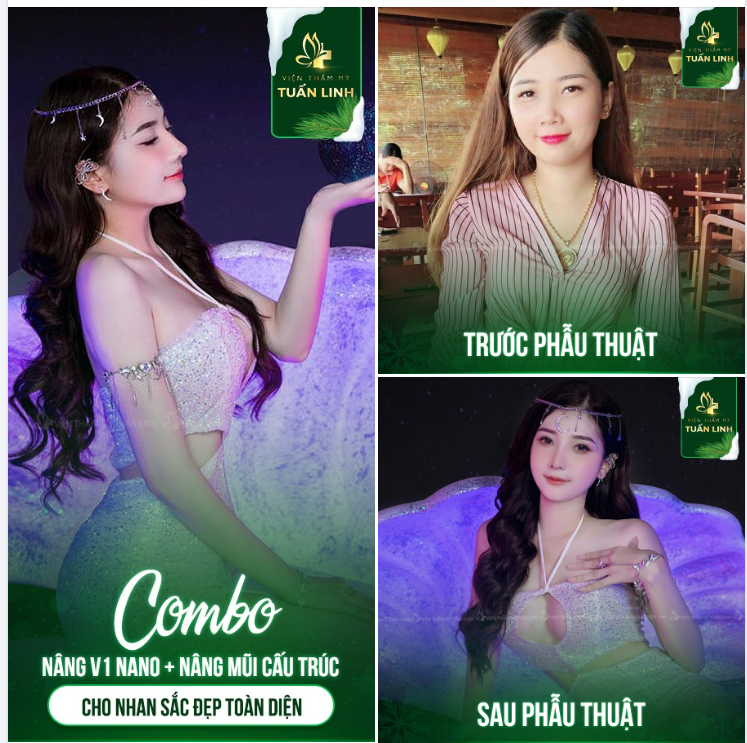 NÂNG V1 + NÂNG MŨI => COMBO CHO NHAN SẮC ĐẸP TOÀN DIỆN.