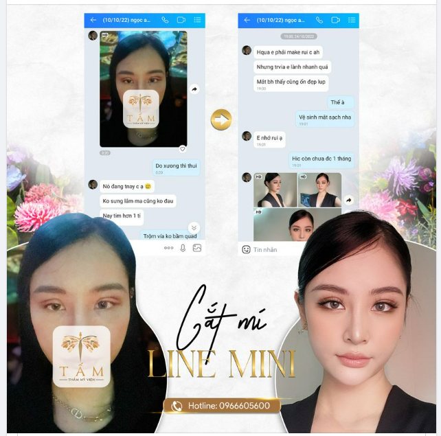 “ Ơ Thẩm Mỹ Viện Tấm lại bị phốt à ” Không sưng nhưng lại tím hơn hôm trước...