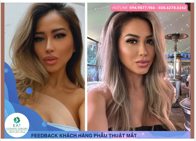 Bạn khách yêu quý sau khi thực hiện phẫu thuật tạo hình mí mắt trên tại KAT một thời gian lung vô cùng linh xinh đẹp và tự nhiên.