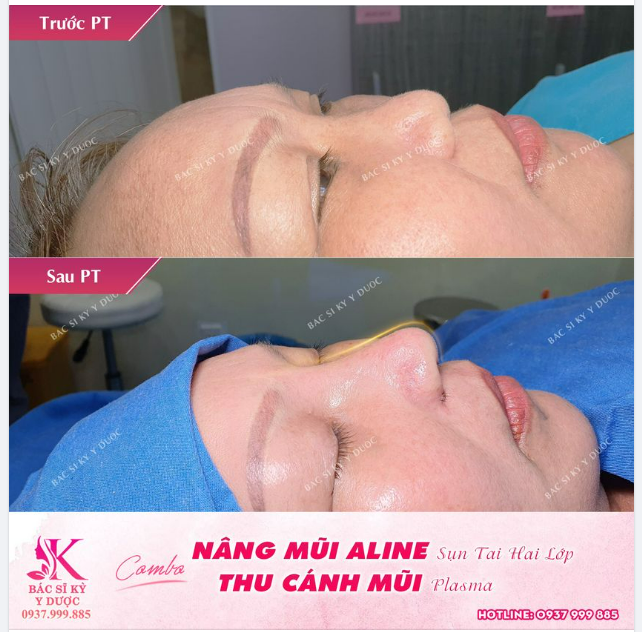 NÂNG MŨI ALINE SỤN TAI 2 LỚP + THU CÁNH MŨI PLASMA