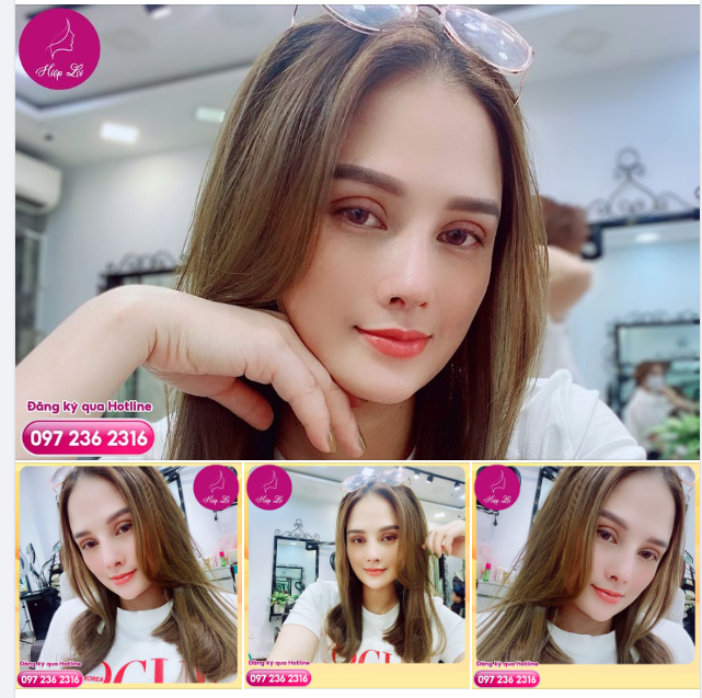 Cô gái 9x Sài Thành đến tư vấn tại Hiệp Lợi trong tình trạng : Mí mắt sụp, mỡ thừa + mũi tẹt, không có sóng mũi.
