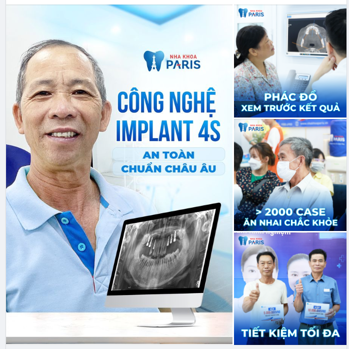 TRỒNG RĂNG CÔNG NGHỆ 4S CÓ GÌ ĐẶC BIỆT?