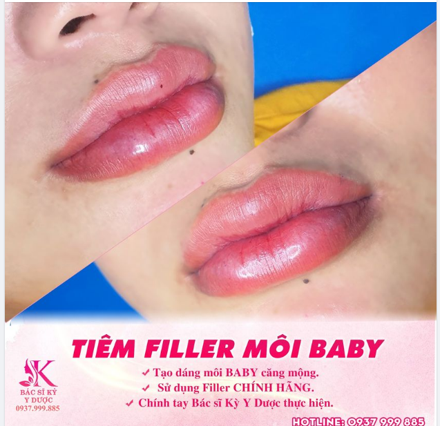 Tiêm filler môi Baby