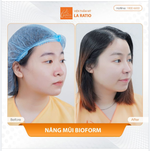 NÂNG MŨI BIOFORM ưu đãi chỉ còn 21TR, duy nhất tháng 11!