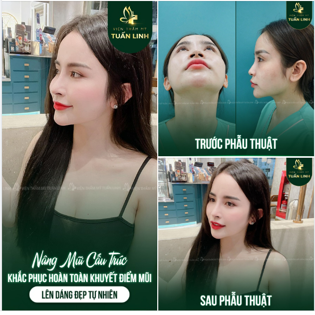 Một chiếc mũi cao cho nàng thêm tỏa sáng