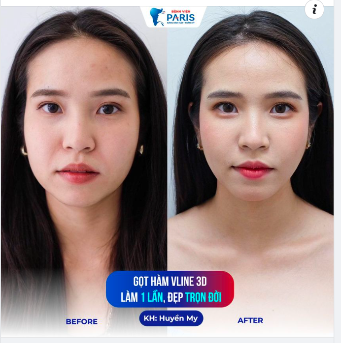 Mặt Vline - ĐẸP KỊP TẾT