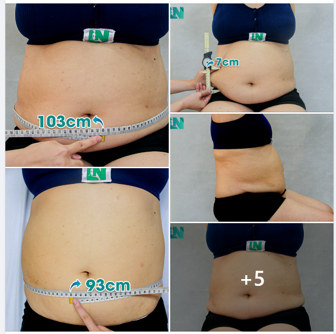 CHỊ KH 48 TUỔI ĐẾN TỪ ĐẮK NÔNG, THAY ĐỔI DÁNG VÓC VỚI VÒNG BỤNG HƠN 1 MÉT