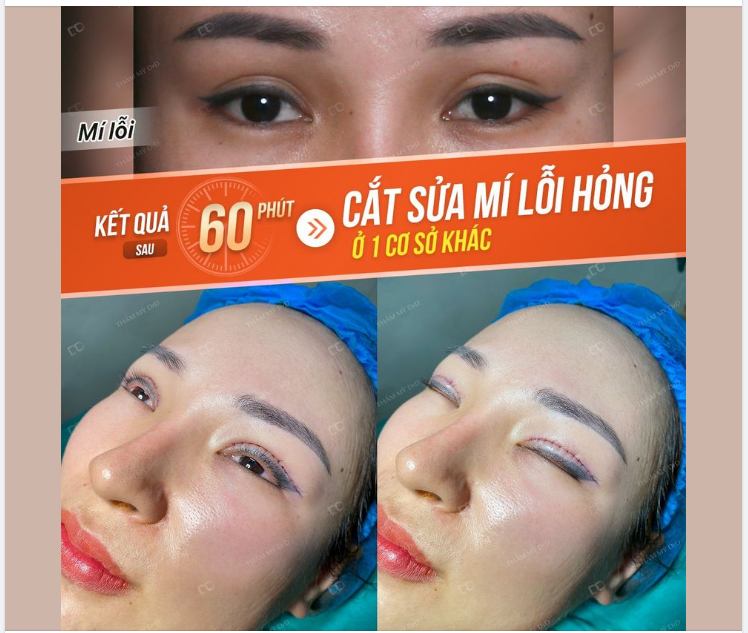 MÍ SPA SAU KHI ĐƯỢC BÁC SĨ VÂN SỬA LẠI SẼ NHƯ THẾ NÀO?