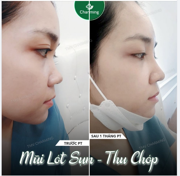 Mũi cao, mũi lượn thường là những chiếc mũi đẹp.