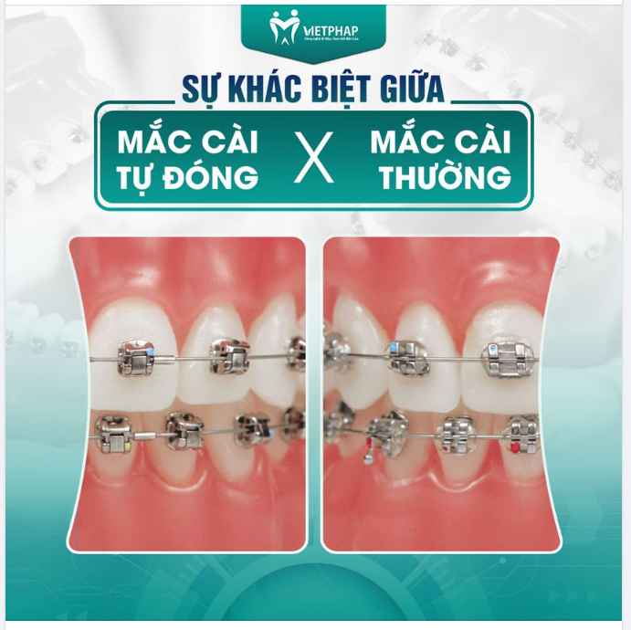 NIỀNG RĂNG MẮC CÀI TỰ ĐÓNG KHÁC GÌ MẮC CÀI THƯỜNG?