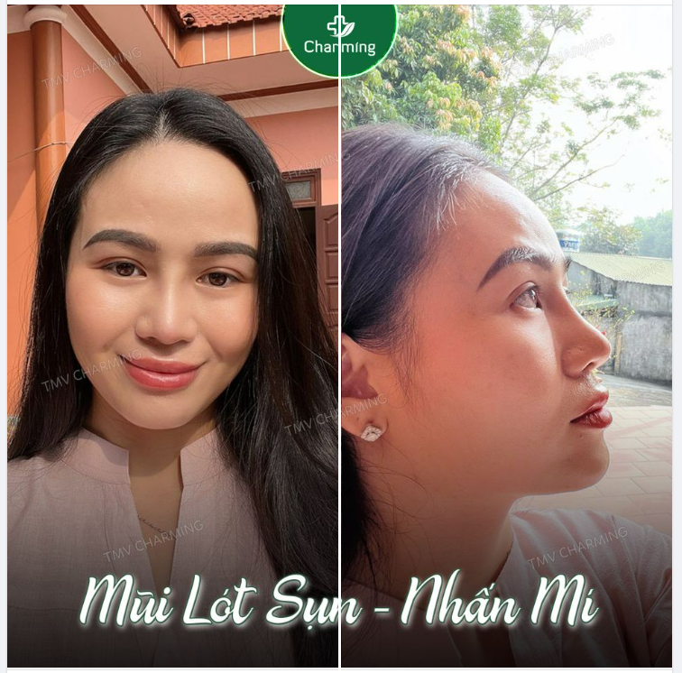 Mọi người thấy không, mái nhà thẳng thế mà còn không thẳng bằng chiếc mũi lót sụn em vừa làm tại Charming