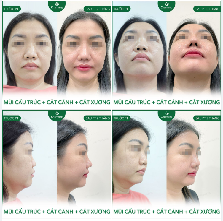 Nhìn từ góc nghiêng hẳn nhiều bạn nghĩ ca này chỉ cần nâng mui lót sụn là được.